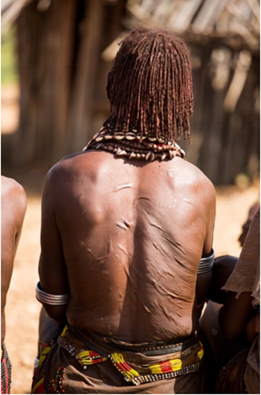 Scars on woman's back